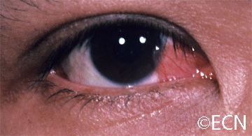 A nasal pterygium is noted to extend onto the cornea.