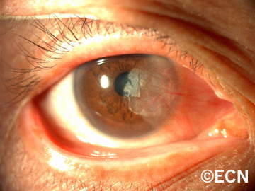 Dit pterygium is over de visuele (pupil)as gegroeid en tast het gezichtsvermogen van de patiënt aan.'s vision. 