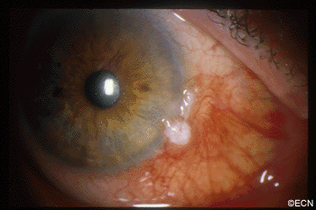 Squamous Conjunctival Carcinoma: Note the white nodular thickening at the limbus.