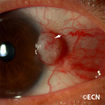 conjunctival squamous cell carcinoma