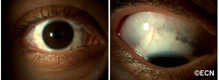 Ocular Melanosis: Episcleral and uveal hyperpigmentation without eyelid skin involvement is called "Ocular Melanosis"