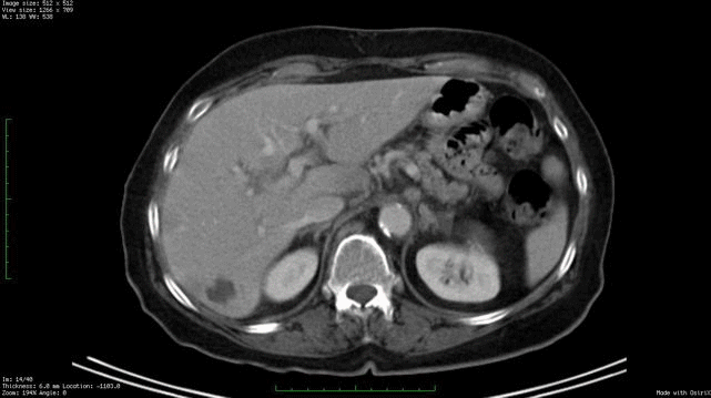 Abdominal Section: Note that the fusion of the black and white forms seen on CT with the color (metabolic activity seen on PET) reveals liver metastasis.