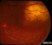 Choroidal metastasis invading central vision