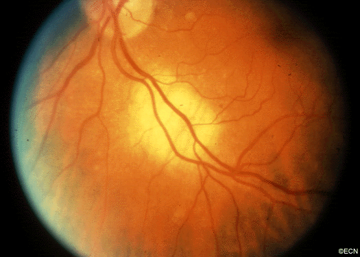 A small choroidal breast metastasis, the larger tumor was in the other eye.