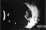 Ultrasound of a dome-shaped Choroidal Melanoma