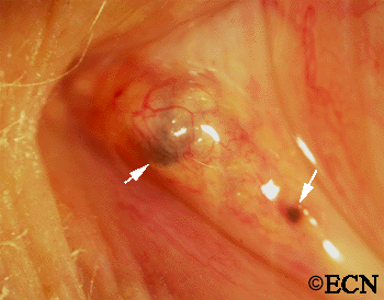 A variably pigmented tumor of the caruncle was noted to grow over a 6-month period. Note the hyper-vascularity over the apex and subconjunctival pigment deposits (arrows).