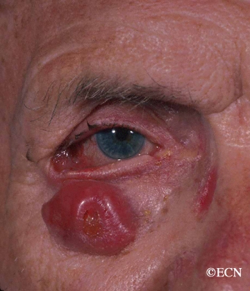 Eyelid Tumors New York Eye Cancer Center