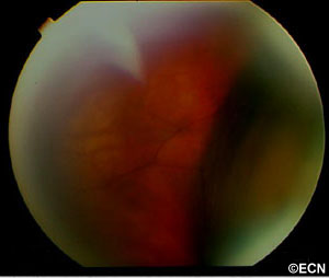 Fundus photograph reveals a dark retinal elevation in the nasal quadrant. Similar less significant elevations were present in the other three quadrants.
