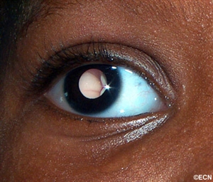 Leukocoria with tumor visible through the right pupil. Note the clear cornea and lack of orbital signs.