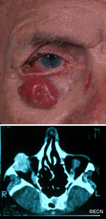 Note the large nodular basal cell carcinoma on the right lower eye lid and cheek prior to cis-platinum chemotherapy.