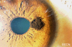 Note the multinodular peripupillary pigmented tumor which slightly deforms the iris.