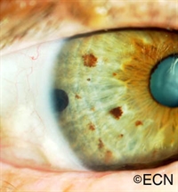 This digital image shows a rounded pigmented tumor extending from the anterior chamber angle.