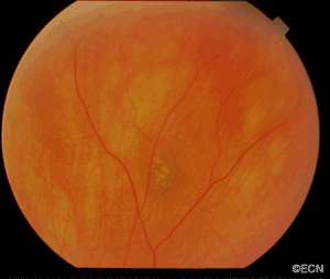 This series of fundus photographs were taken during her consultation but at different levels of illumination.