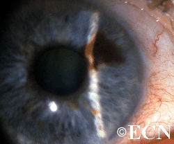 Though relatively small, this tumor caused ectropion uveae, pigment liberation, and sector cataract.