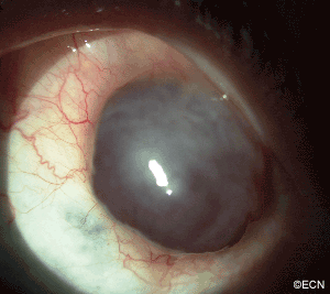 A digital slit-lamp photograph of a pigmented conjunctival tumor in the superonasal quadrant. The anterior, superior, inferior, and posterior margins are visible. The episcleral margin is obscured by the tumor.