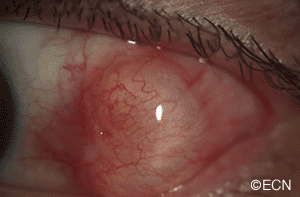 A digital slit-lamp photograph of a conjunctival cyst overlying the insertion of the lateral rectus muscle. The anterior, superior and inferior margins are clearly visible. The posterior and episcleral margins are not visible. There is also a question as to the involvement of the lateral rectus muscle.