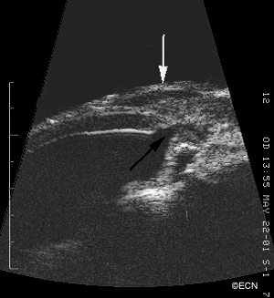 High-frequency Ultrasonography reveals the open sclerostomy (black arrow) and the overlying low-reflective tumor (white arrow). Note that the ciliary body is highly reflective (unlike the tumor). A multicystic bleb is noted on transverse section. High-frequency ultrasound obtained with the 20 MHz probe.
