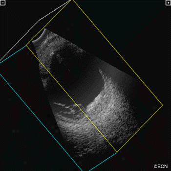 A RetCam digital image reveals an amelanotic subretinal tumor with intrinsic vascularity.
