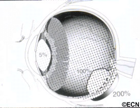 Eye-Plaque Radiotherapy: Graphic demonstration