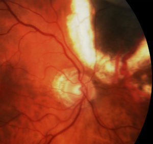 Laser demarcation in an effort to avoid intravitreal anti-VEGF injections. 