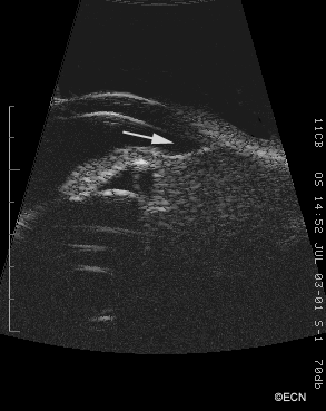 10 and 20 MHz Ultrasonography. High frequency ultrasound (20 MHz) reveals displacement of the iris root (arrow). Though no sclerostomy is seen, the inner and outer scleral borders are poorly defined. 10 MHz ultrasonography shows an irregularly shaped tumor > 16 mm in diameter.