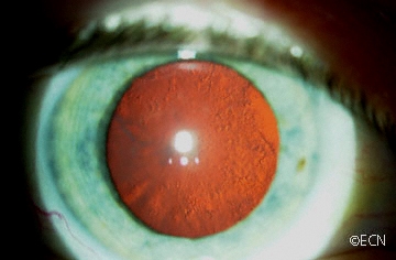 posterior subcapsular cataract