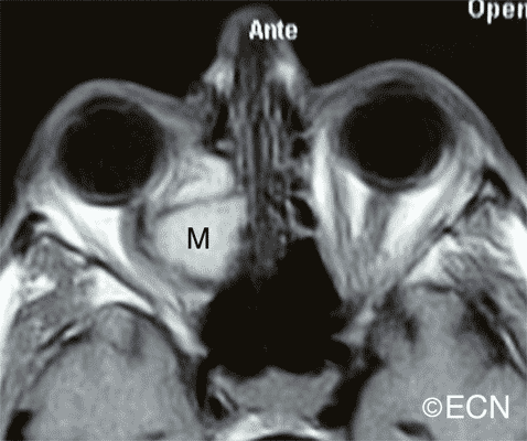 Case #18: Orbital Mucocele MRI Images