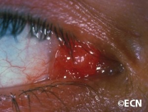 Conjunctival papilloma removal