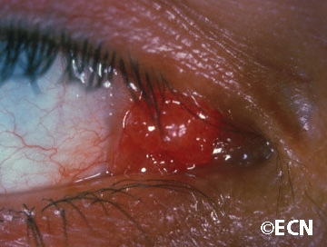 Conjunctival papilloma excision