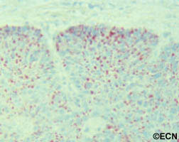 Biopsy usually requires a full thickness lid section sent for histopathologic evaluation prior to formalin fixation. Histopathologic evaluation reveals foamy cytoplasm (with hematoxylin and eosin) This specimen is found to be oil-red-o positive, consistent with sebaceous carcinoma. *note* Sebaceous carcinomas may occur several years before a gastrointestinal malignancy. This occurrence has been described as the autosomal dominant - Muir-Torre Syndrome. 