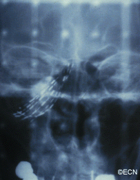 After seed implantation, an x-ray is used to document radioactive seed locations and allow for in vivo dosimetry.