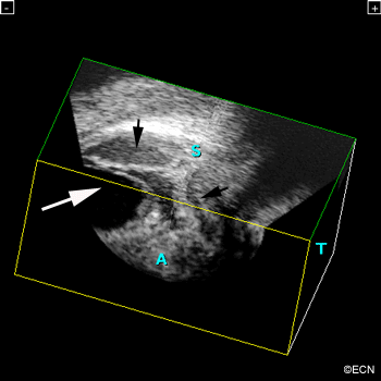 [10 MHz] 3D Ultrasonography Reveals - *Note* Ultrasonography reveals an open funnel retinal detachment (white arrow). Note the echolucent vitreous humor. The posterior choroidal detachments (black arrows) exhibit variable internal reflectivity consistent with blood. A = anterior, S = superior, T = temporal.