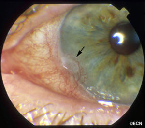 There was keratinization of the overlying corneal epithelium