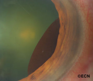 Case #16: The iris pigment epithelial cyst seen after dilation of the pupil.