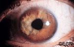 A diffuse iris melanoma causing severe glaucoma was too large to remove or irradiate and was treated by enucleation. 