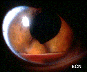 Leukemic Infiltrate of the Anterior Chamber - Hypopyon with Hyphema