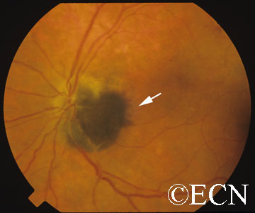 Note the dark tumor located next to and within the optic nerve. The edges have a feathered appearance (arrow).