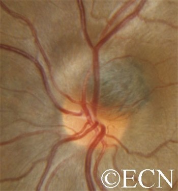 Most optic nerve melanocytomas are small, black, and do not grow. A medium-sized juxtapapillary melanocytoma