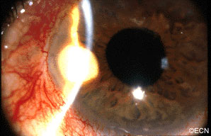 Slit-lamp photography shows the white pearl-cyst within the temporal iris stroma. In this case, a history of tumor growth and a mild iritis were noted. 