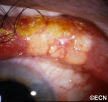 Sebaceous cell carcinoma is suspected due to evidence of eyelash loss and the formation of a yellow-nodule. This tumor can also present as a persistent (months) non-responsive blepharitis or conjunctivitis. In these cases, a high index of suspicion for sebaceous cell carcinoma will lead to biopsy and the diagnosis. Once sebaceous carcinoma is suspected a biopsy is warranted. Before surgery, the pathologist should be advised of this possible diagnosis so the specimen can be processed appropriately 