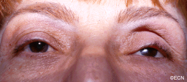 Drooping of the left upper eye lid (ptosis) 