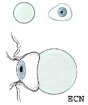The implant sits in the orbit and behind the ocular prosthesis. 