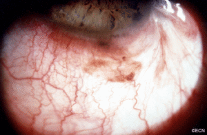 pigmented tumor "melanoma" in the conjunctiva.