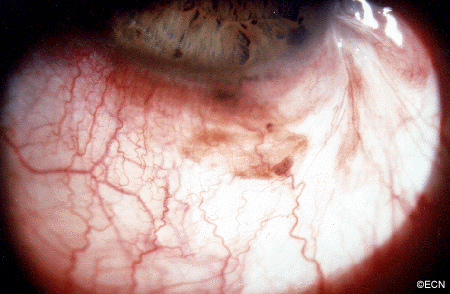 pigmented tumor "melanoma" in the conjunctiva.