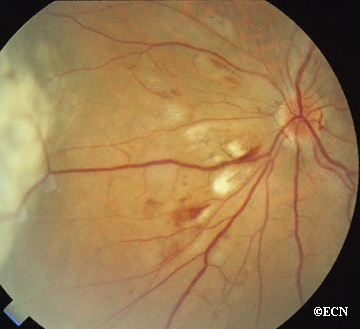 Early radiation retinopathy 
