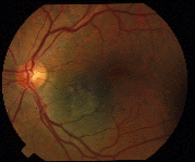 A suspicious choroidal nevus with orange pigment.