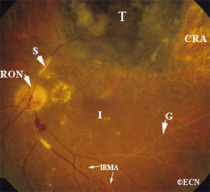 late radiation retinopathy