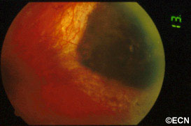 The same tumor 2 years after Pd-103 ophthalmic plaque radiation therapy.