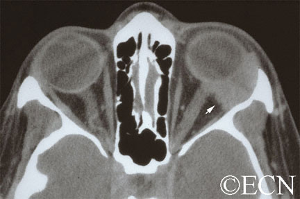 Computed Radiographic Tomography (CT) demonstrates and Adenoid Cystic Carcinoma of the Lacrimal Gland with Orbital Extension (arrow) 