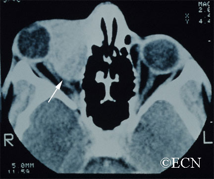Computed Tomography (CT) shows a large lymphangioma (arrow), pushing the eye out of the orbit. 